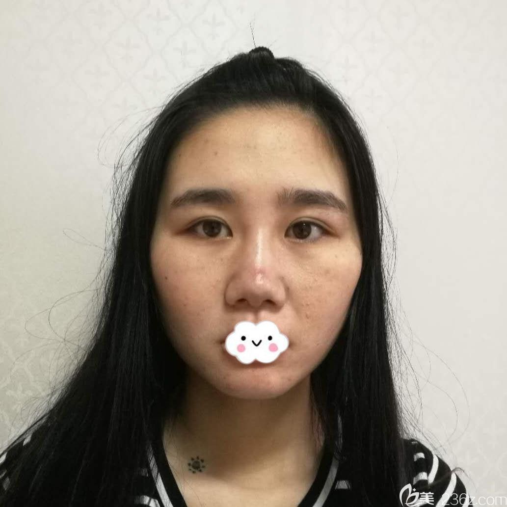 武汉卓美硅胶假体垫下巴真人案例 武汉卓美硅胶假体垫下巴真人案例