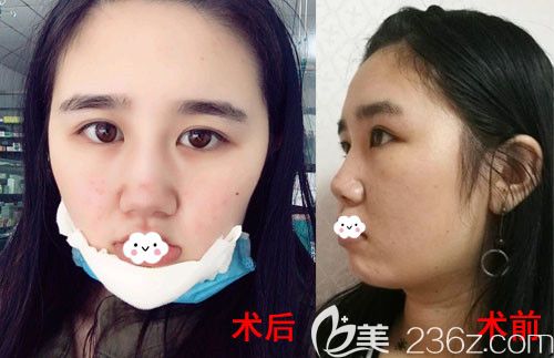 武汉卓美硅胶假体垫下巴术后第1天与术前对比图 武汉卓美硅胶假体垫下巴术后第1天与术前对比图