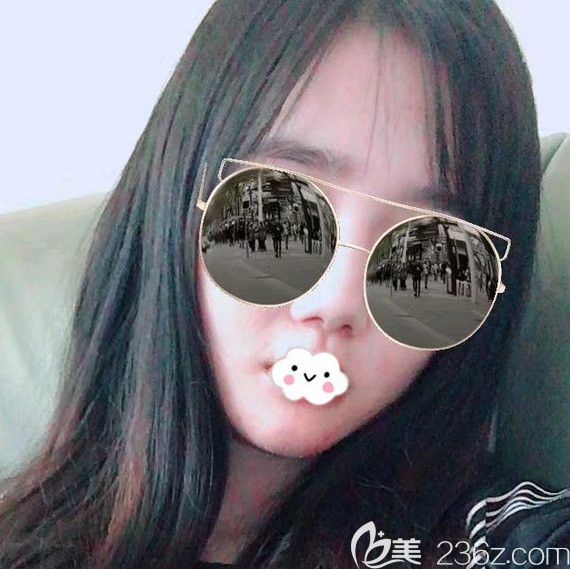 武汉卓美硅胶假体垫下巴术后第6天恢复效果图 武汉卓美硅胶假体垫下巴术后第6天恢复效果图