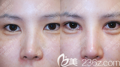 崔源哲院长歪鼻手术案例