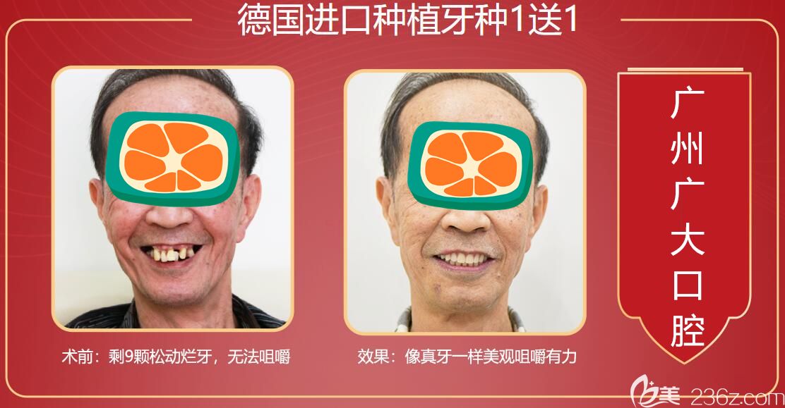 广州广大种植牙前后对比图 广州广大种植牙前后对比图