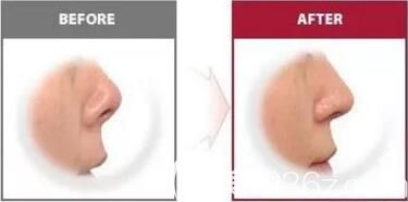 假体隆鼻出现包膜挛缩修复后前后效果对比照
