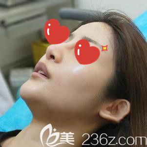 李杰医生帮我做玻尿酸隆鼻术后即刻