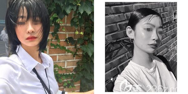 术前面诊南京韩辰医生咨询嘴唇整形 术前面诊南京韩辰医生咨询嘴唇整形