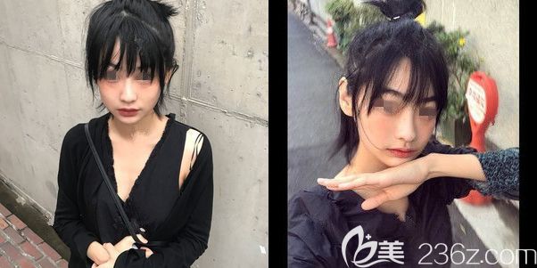 M唇术后一个月恢复 M唇术后一个月恢复