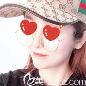 李杰医生做玻尿酸隆鼻术后20天鼻梁处轻微肿胀