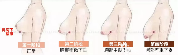 乳房下垂4个不同阶段