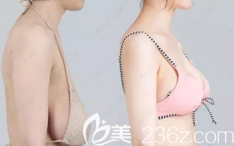 乳房下垂悬吊术案例前后效果对比图