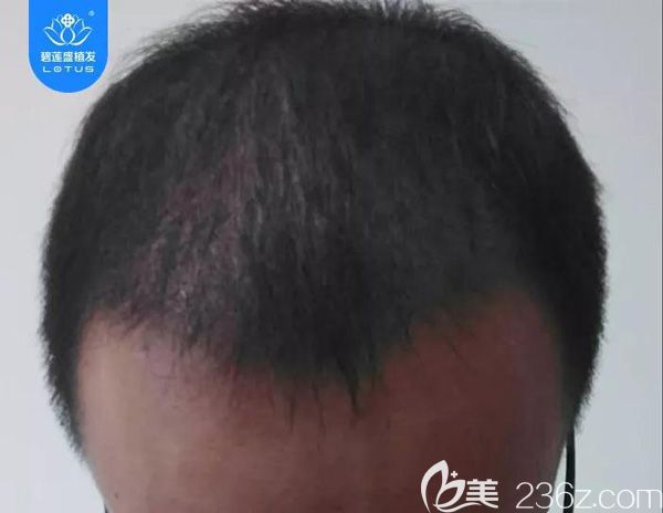 大面积植发术后3个月脱发期效果 大面积植发术后3个月脱发期效果