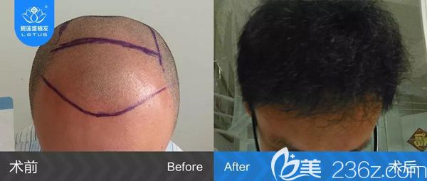 6级脱发植发4500单位前后对比效果图 6级脱发植发4500单位前后对比效果图