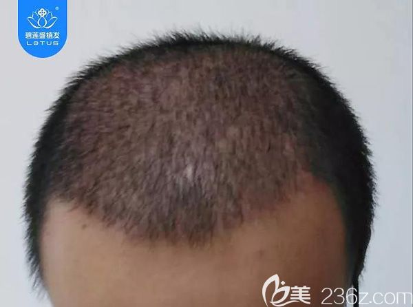 植发4500单位术后一个月效果图 植发4500单位术后一个月效果图