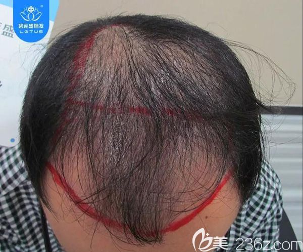 ​6级脱发植发4500单位，看看狂脱期后头发会呈现怎样的效果？