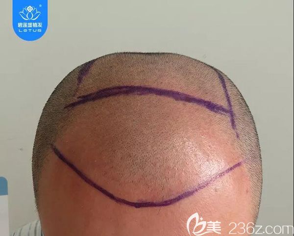 大面积植发术前设计 大面积植发术前设计