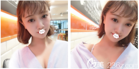 梅州曙光自体脂肪丰胸1个月效果图