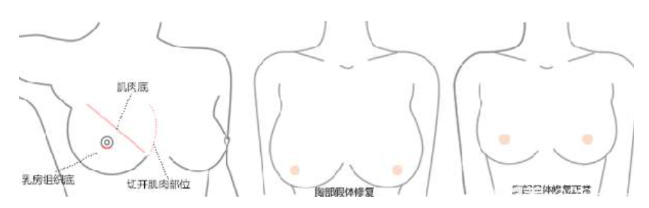 隆胸失败修复方法示意图