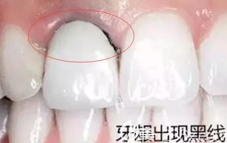 =牙龈黑线 =牙龈黑线