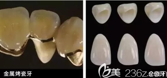 全瓷牙和烤瓷牙图片 全瓷牙和烤瓷牙图片