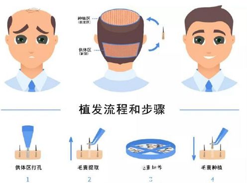 长沙岱高FUE植发手术流程 长沙岱高FUE植发手术流程