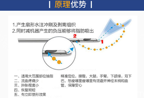 <!--<i data=20240709-sp></i>-->医院吸脂优势 <!--<i data=20240709-sp></i>-->医院吸脂优势