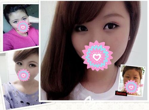 眯眯眼通过南阳华美的双眼皮术成功变美