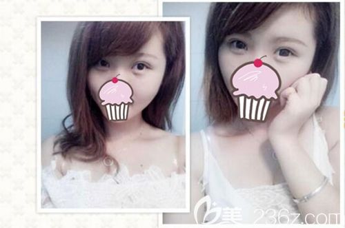 南阳华美王培生医生做的双眼皮效果