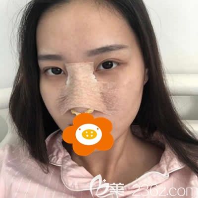 董彭涛医生做硅胶隆鼻手术后第二天