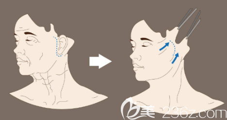 韩国原辰拉皮手术