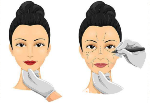 韩国原辰拉皮手术怎么样？