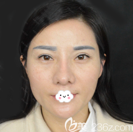 在深圳非凡做双眼皮修复和隆鼻术前照片 在深圳非凡做双眼皮修复和隆鼻术前照片