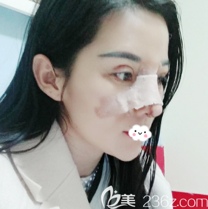 找深圳非凡梅够明做双眼皮修复和隆鼻术后三天 找深圳非凡梅够明做双眼皮修复和隆鼻术后三天