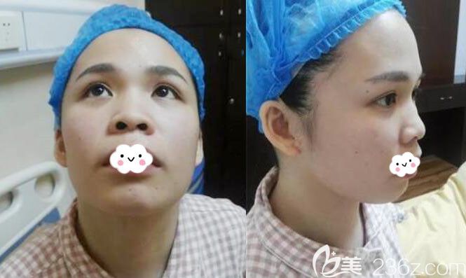 孝感天妃合资艳冠假体垫下巴案例 孝感天妃合资艳冠假体垫下巴案例