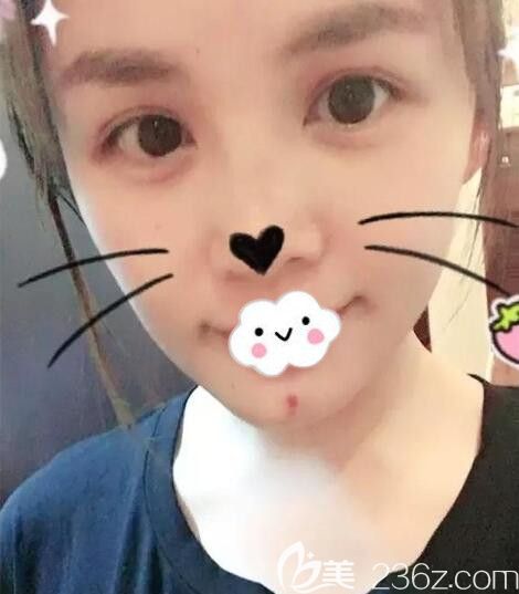 孝感天妃硅胶假体垫下巴术后8天恢复图 孝感天妃硅胶假体垫下巴术后8天恢复图