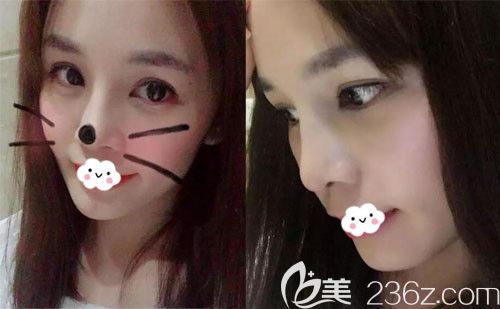 孝感天妃假体垫下巴术后15天恢复照片 孝感天妃假体垫下巴术后15天恢复照片