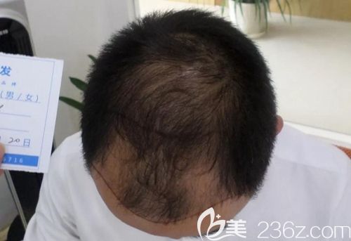 植发前额角稀疏、头顶稀疏 植发前额角稀疏、头顶稀疏