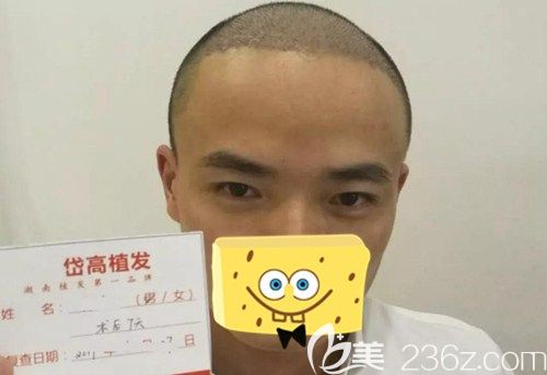 植发7天,看起来像是剪了寸头 植发7天,看起来像是剪了寸头