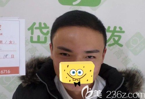 植发7个月, 几乎看不出脱发的痕迹 植发7个月, 几乎看不出脱发的痕迹