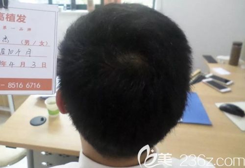植发10个月,后枕部头发几乎没有任何改变 植发10个月,后枕部头发几乎没有任何改变