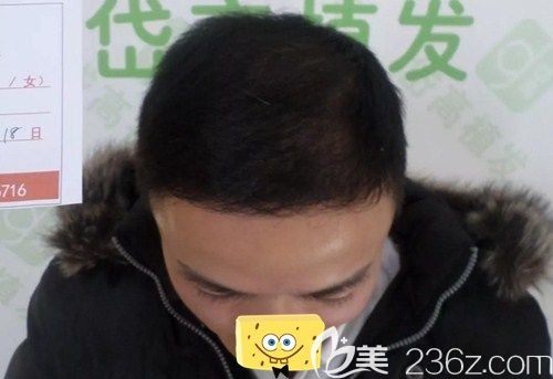 长沙岱高植发7个月后头发成功长出 长沙岱高植发7个月后头发成功长出