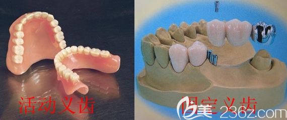 高天医生科普固定义齿修复和活动义齿的维护方法