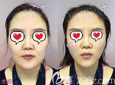 周口缔莱美埋线面部提升效果对比