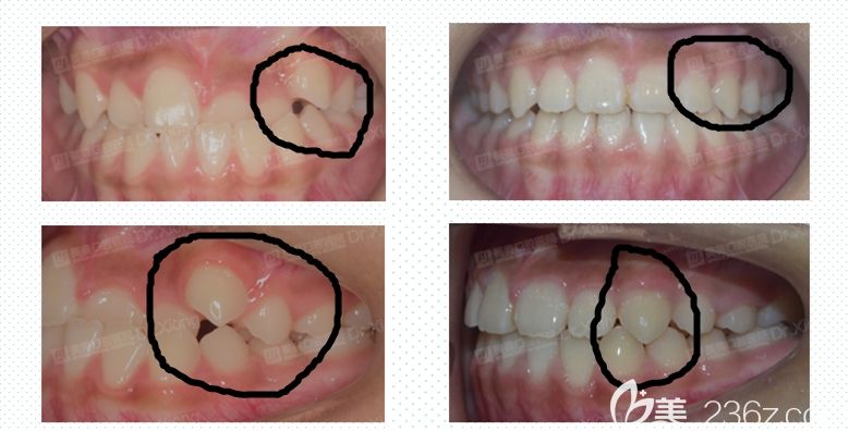 女生虎牙矫正变化图 女生虎牙矫正变化图