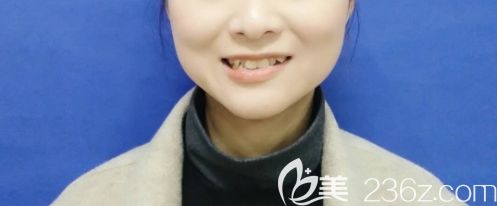 虎牙矫正前图示 虎牙矫正前图示