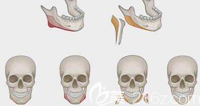 个别人做下颌角切除手术的确会出现骨增生但程度很轻不会影响效果