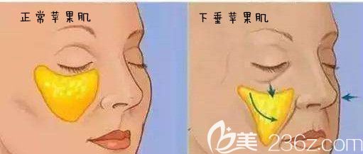正常苹果肌和下垂苹果肌