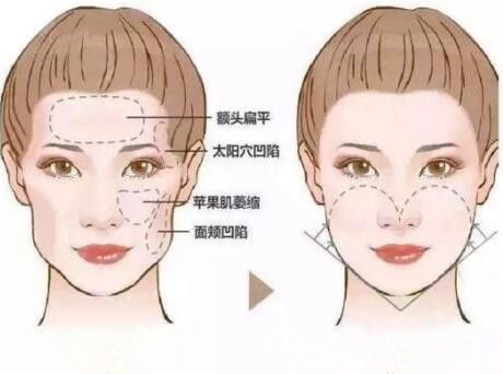 苹果肌填充术前术后对比