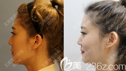 艾恩整形金承俊院长案例