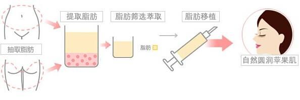 自体脂肪填充苹果肌