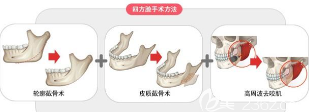武汉涵美<!--<i data=20240703-sp></i>-->医生魔骨去下颌角手术方法 武汉涵美<!--<i data=20240703-sp></i>-->医生魔骨去下颌角手术方法