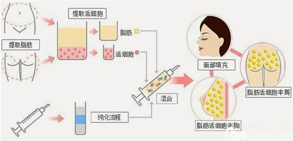 自体脂肪移植填充原理与过程图解 自体脂肪移植填充原理与过程图解
