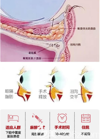 眶隔脂肪释放原理与手术时间 眶隔脂肪释放原理与手术时间